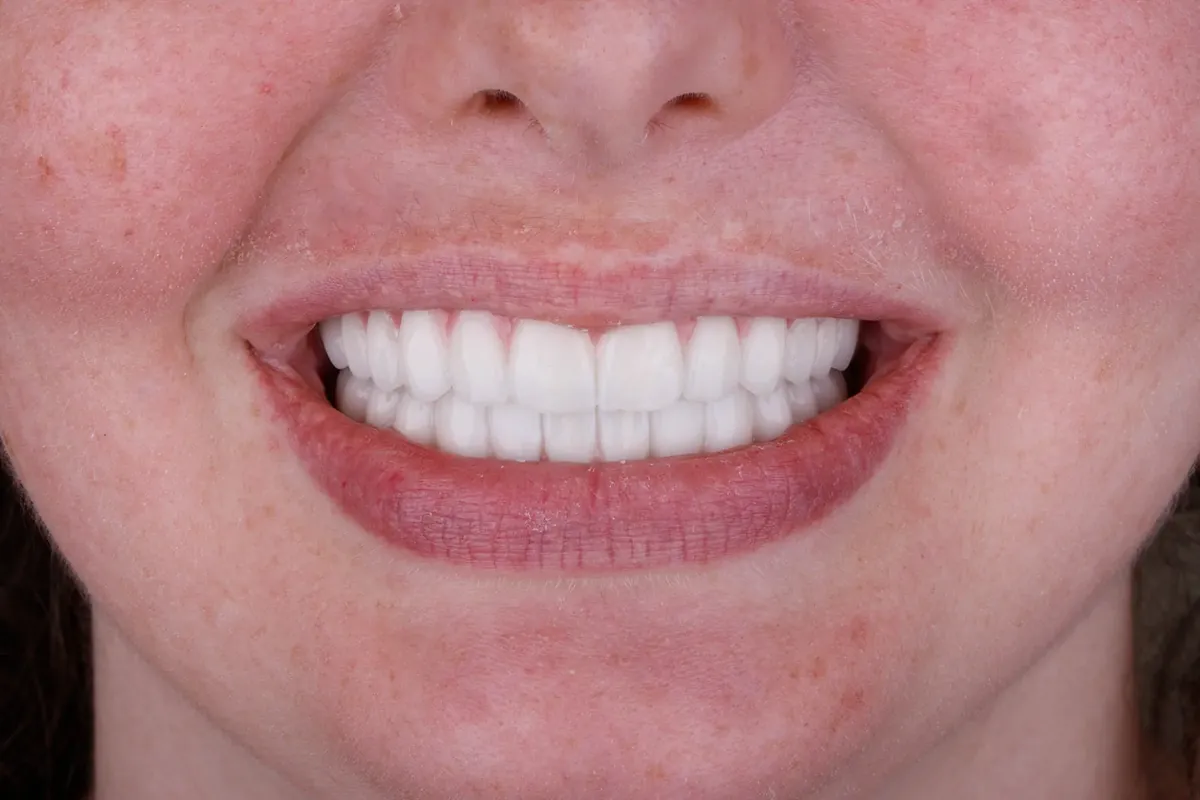 After treatment — Single-tooth implant, anterior