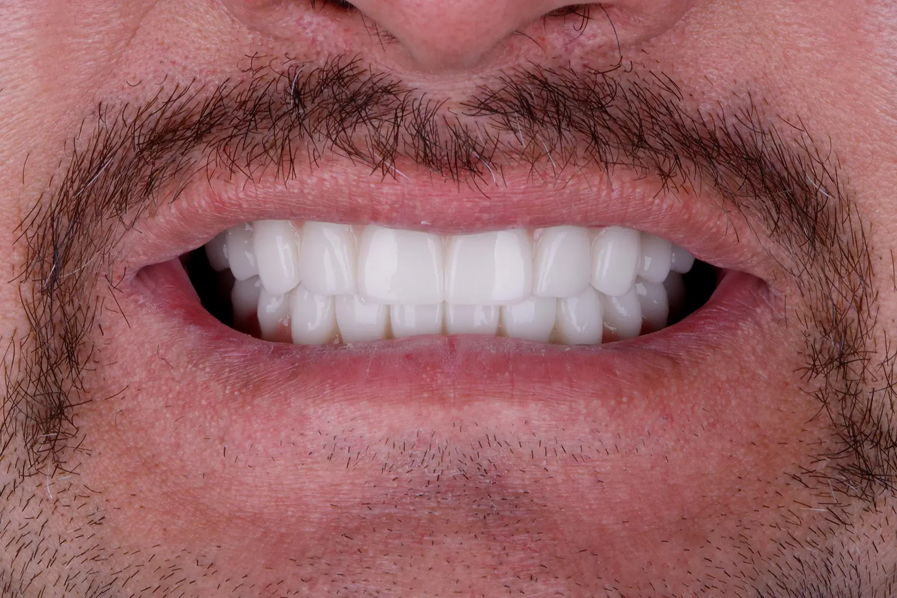 After treatment — Full-arch restoration replacing a partial denture