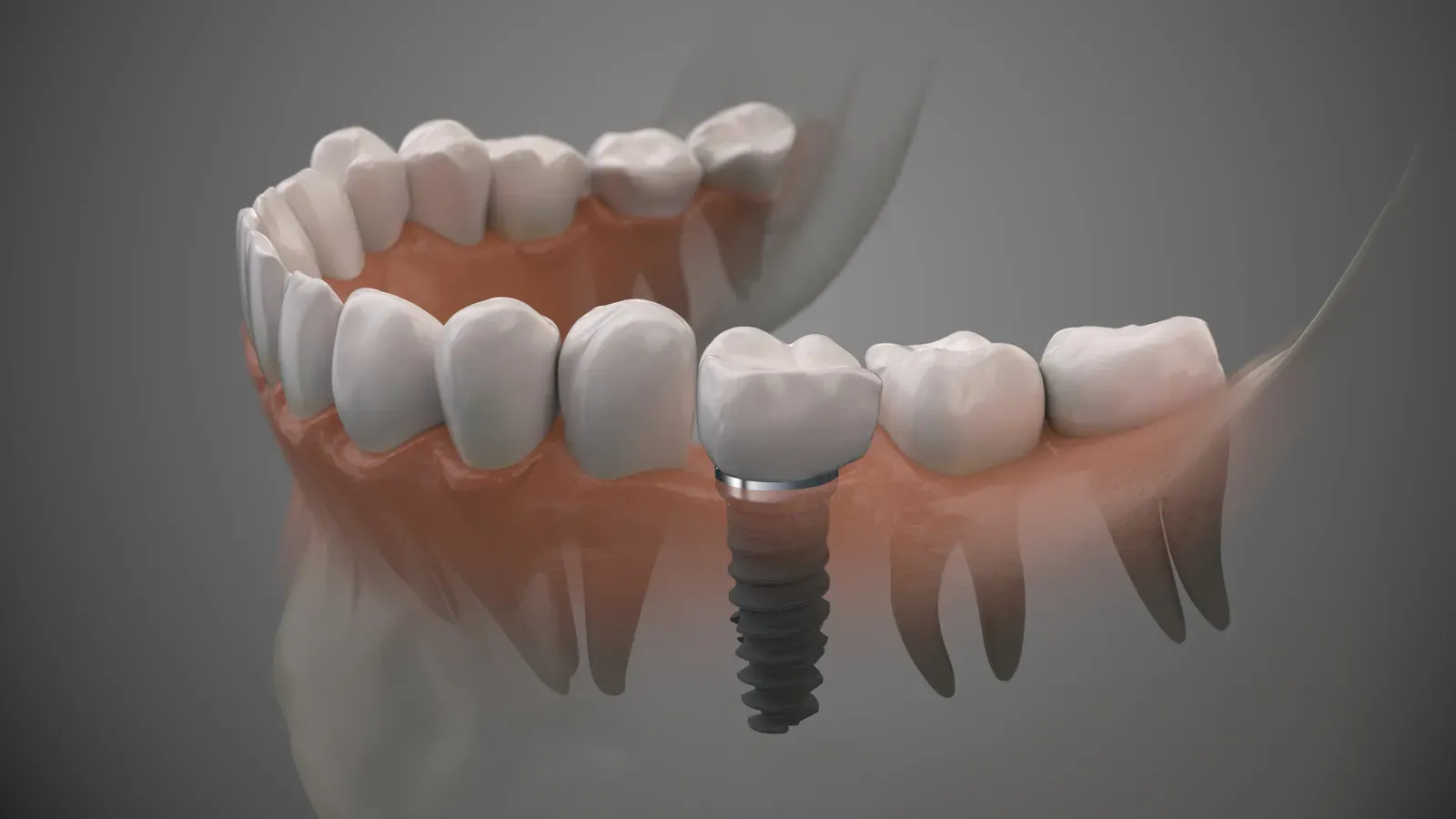 Illustration of a single dental implant placed beside natural teeth