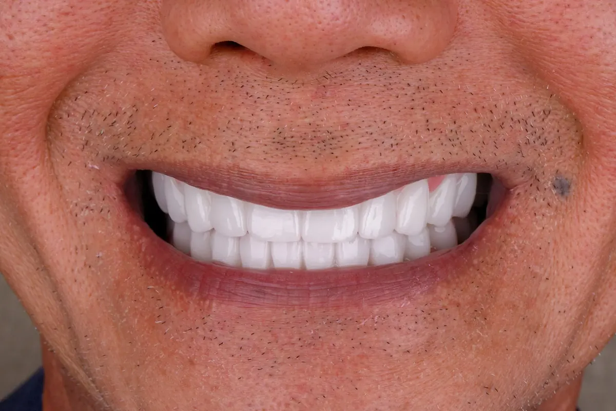 After treatment — Full-arch reconstruction