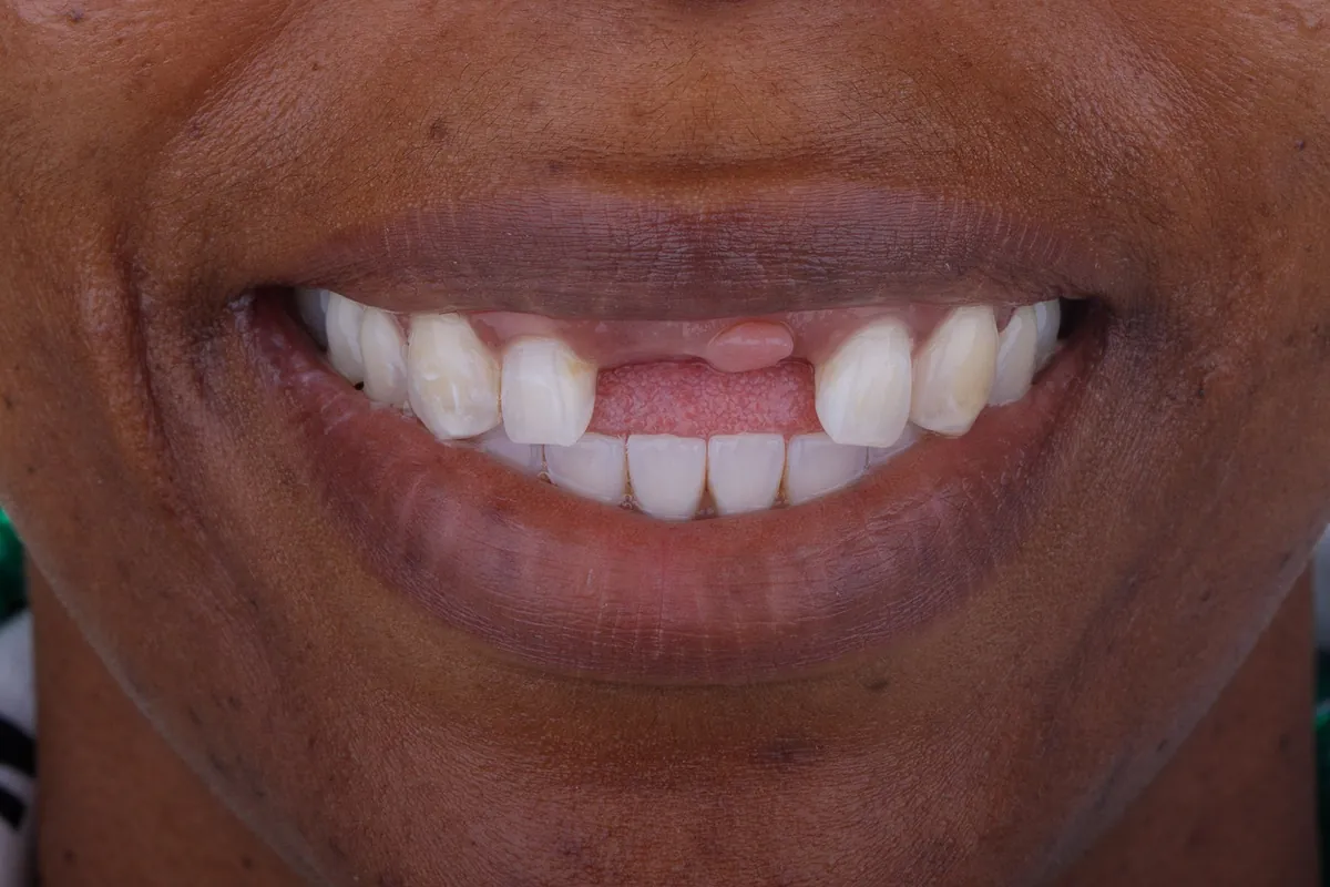 Before treatment — Comprehensive smile makeover