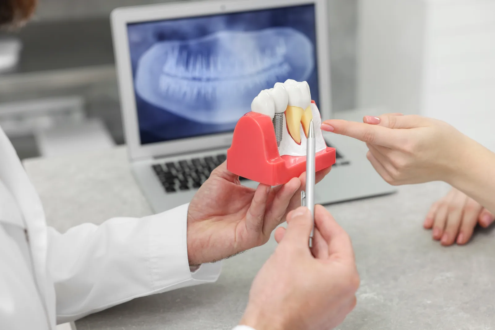 Samuel F. jirik showing patient an educational dental model comparing dental implants vs bridges