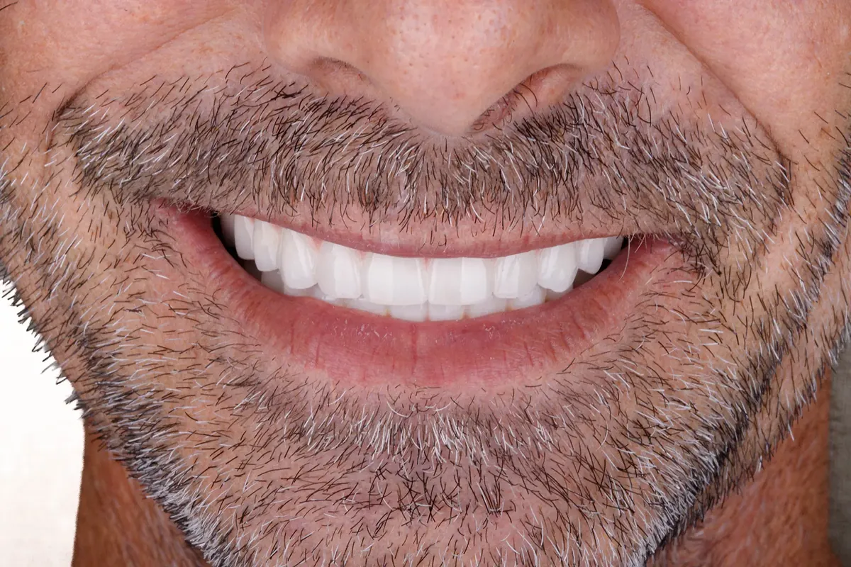 After treatment — Fixed teeth after long-term denture wear