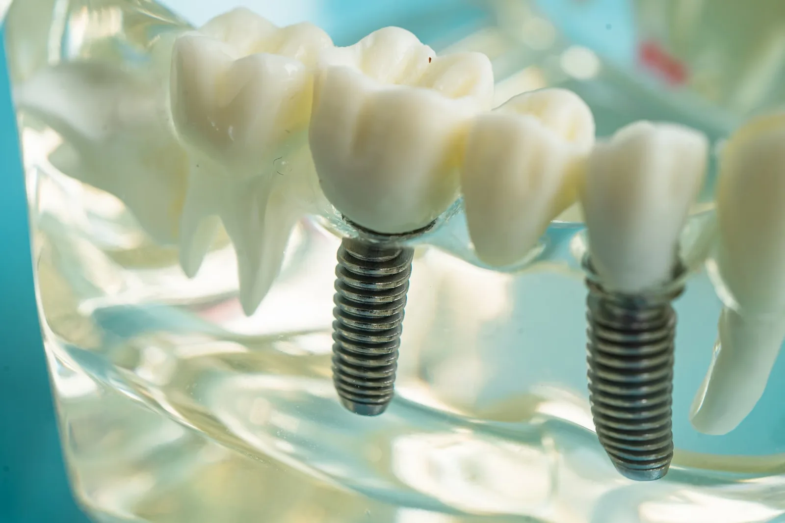 What Happens If You Don’t Replace Missing Teeth? — Samuel F. Jirik DDS, Cabot, Arkansas
