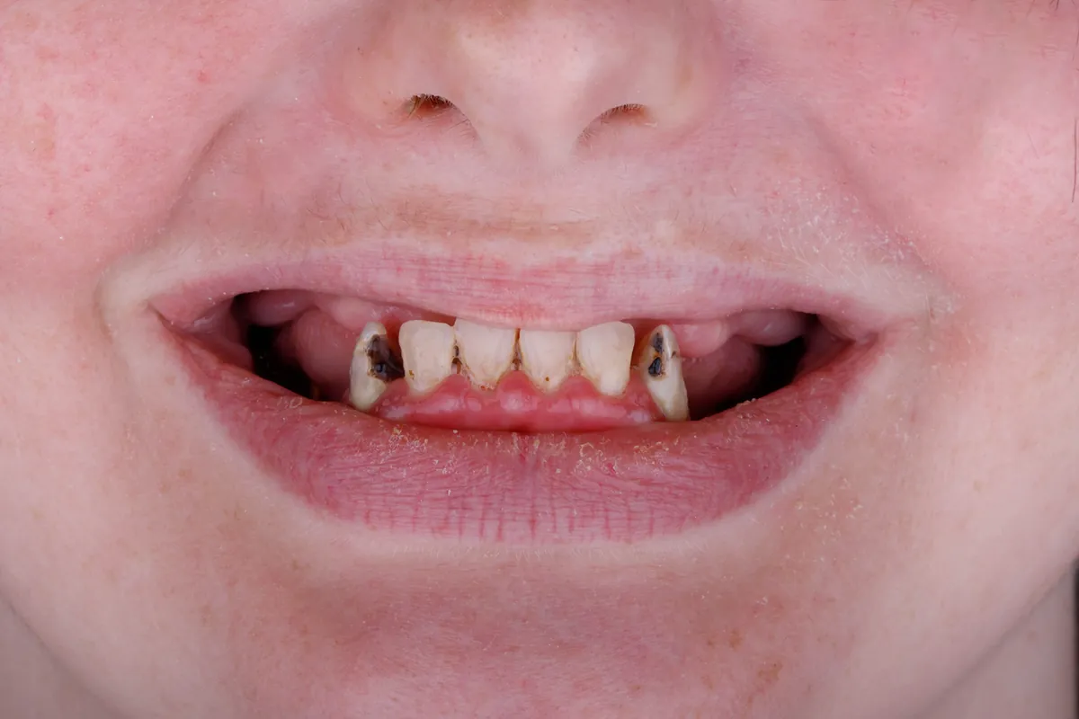 Before treatment — Single-tooth implant, anterior