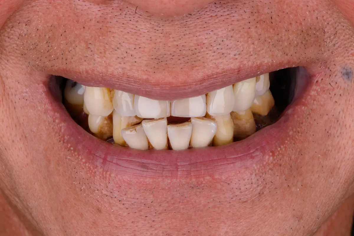 Before treatment — Full-arch reconstruction