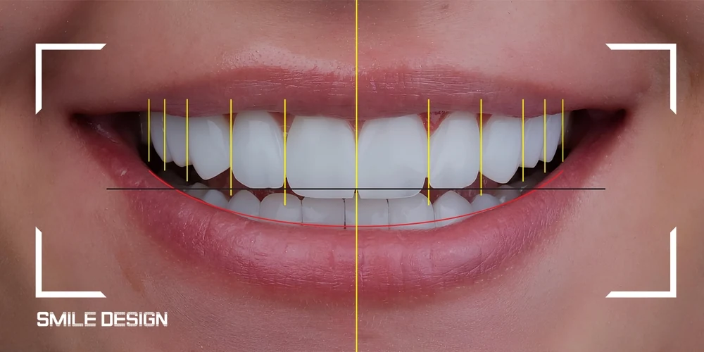 Digital smile design analysis showing tooth alignment and midline over a natural smile