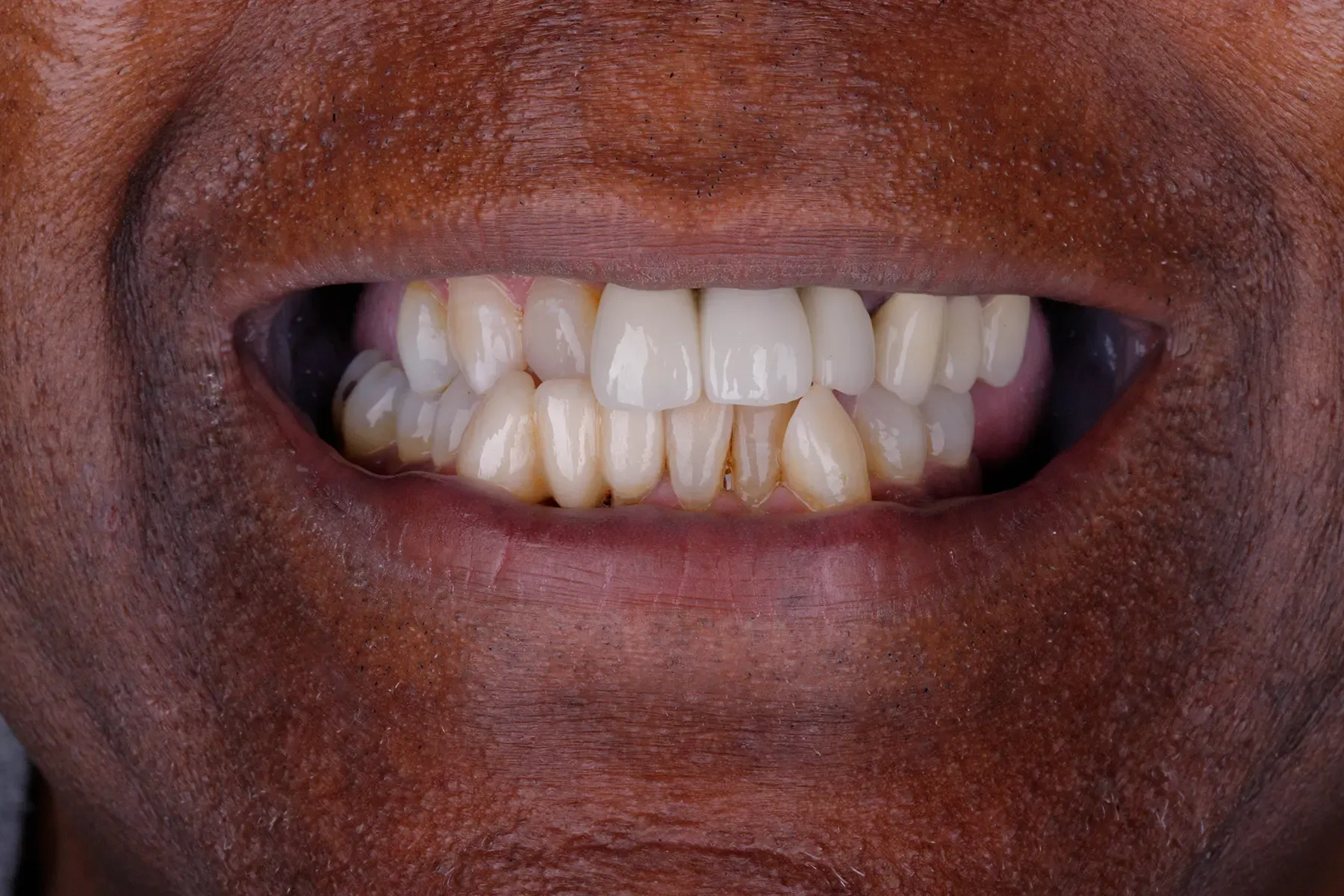 Before treatment — Smile makeover for worn, discolored teeth