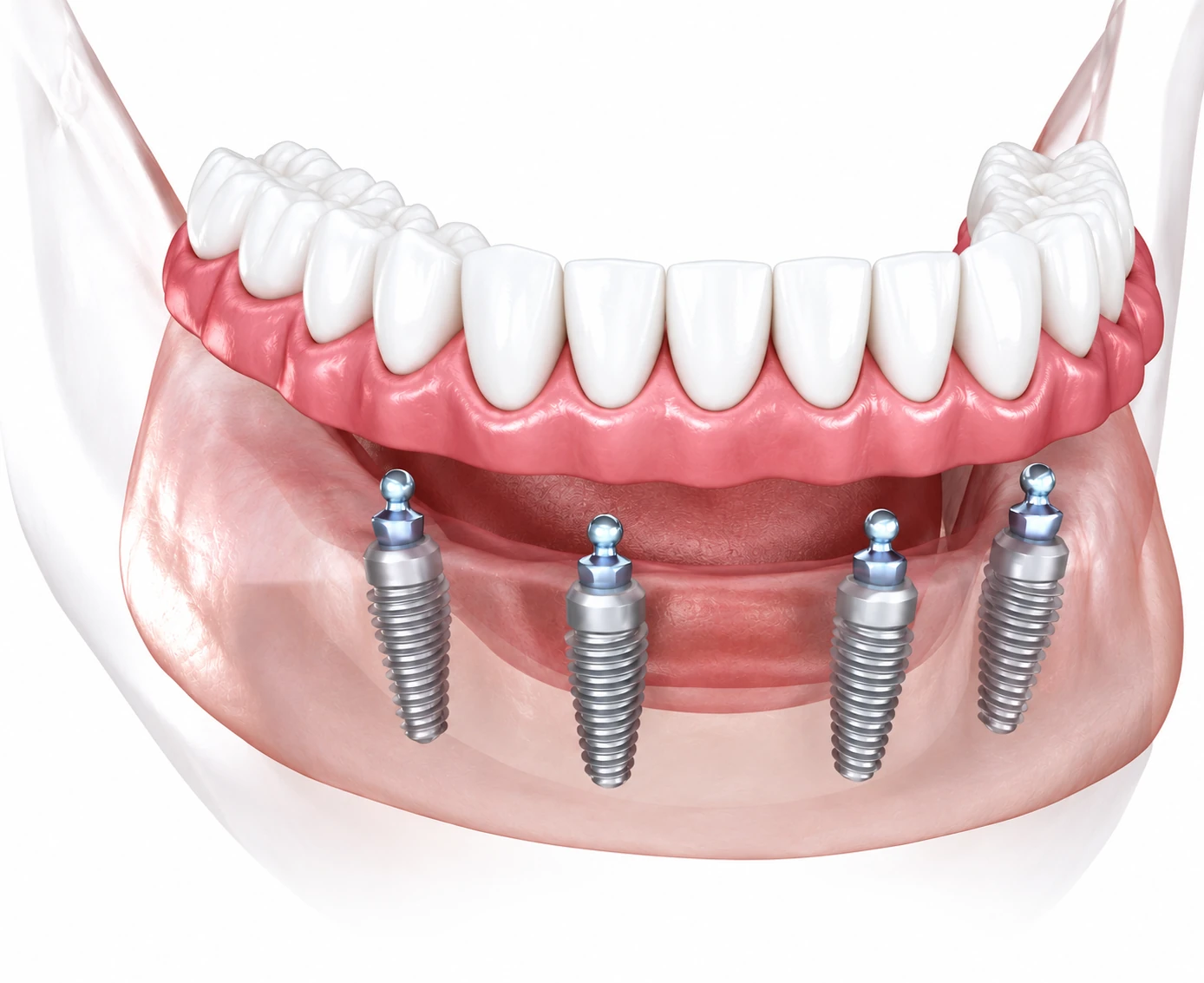 Clinical illustration of an All-on-4 restoration supported by four dental implants