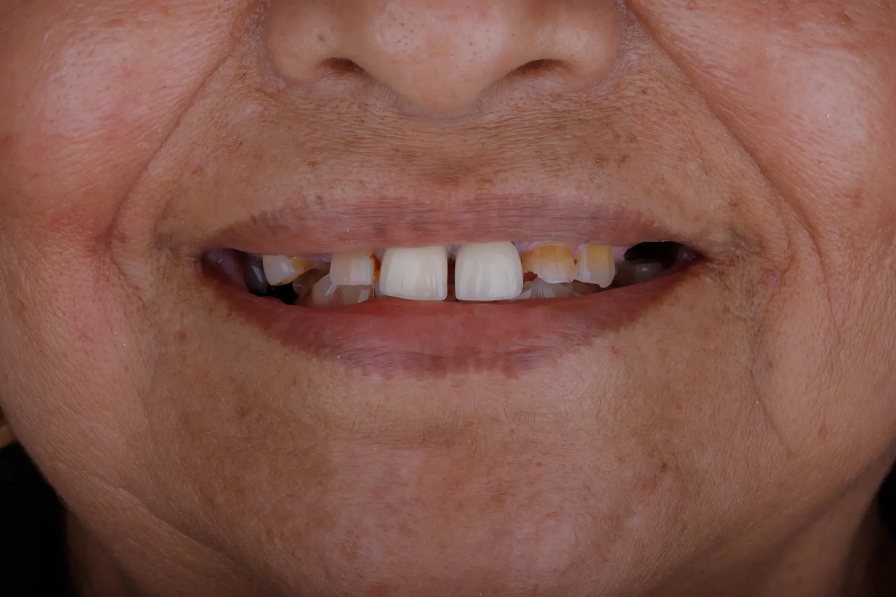 Before treatment — Veneer restoration of a worn, spaced smile