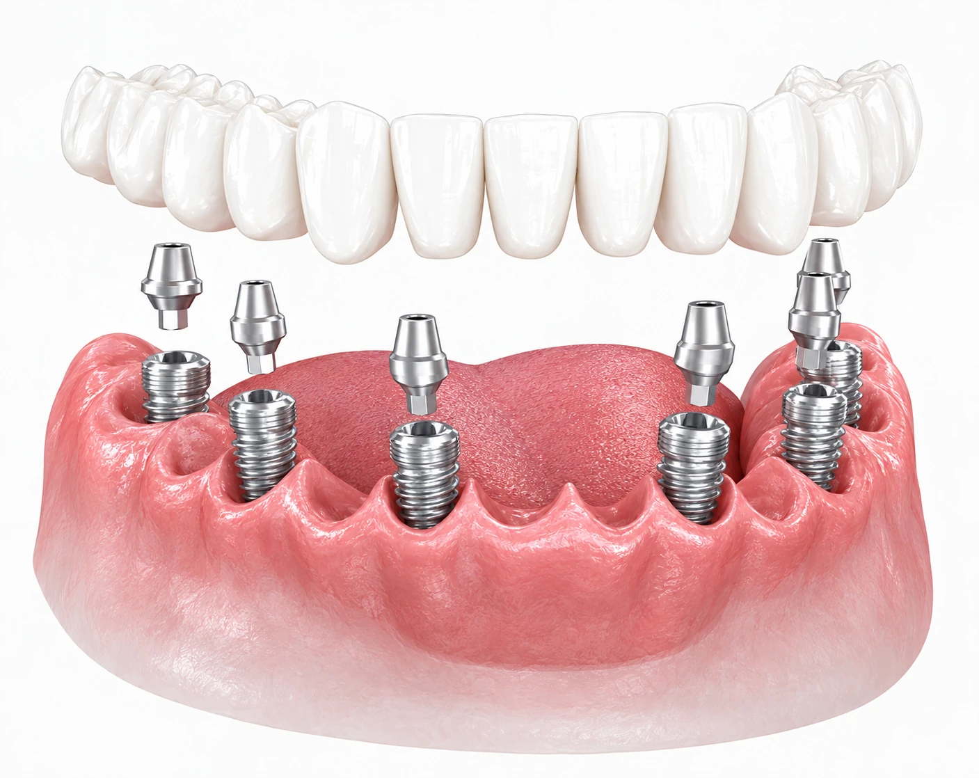 Illustration of a full-arch implant restoration supported by dental implants