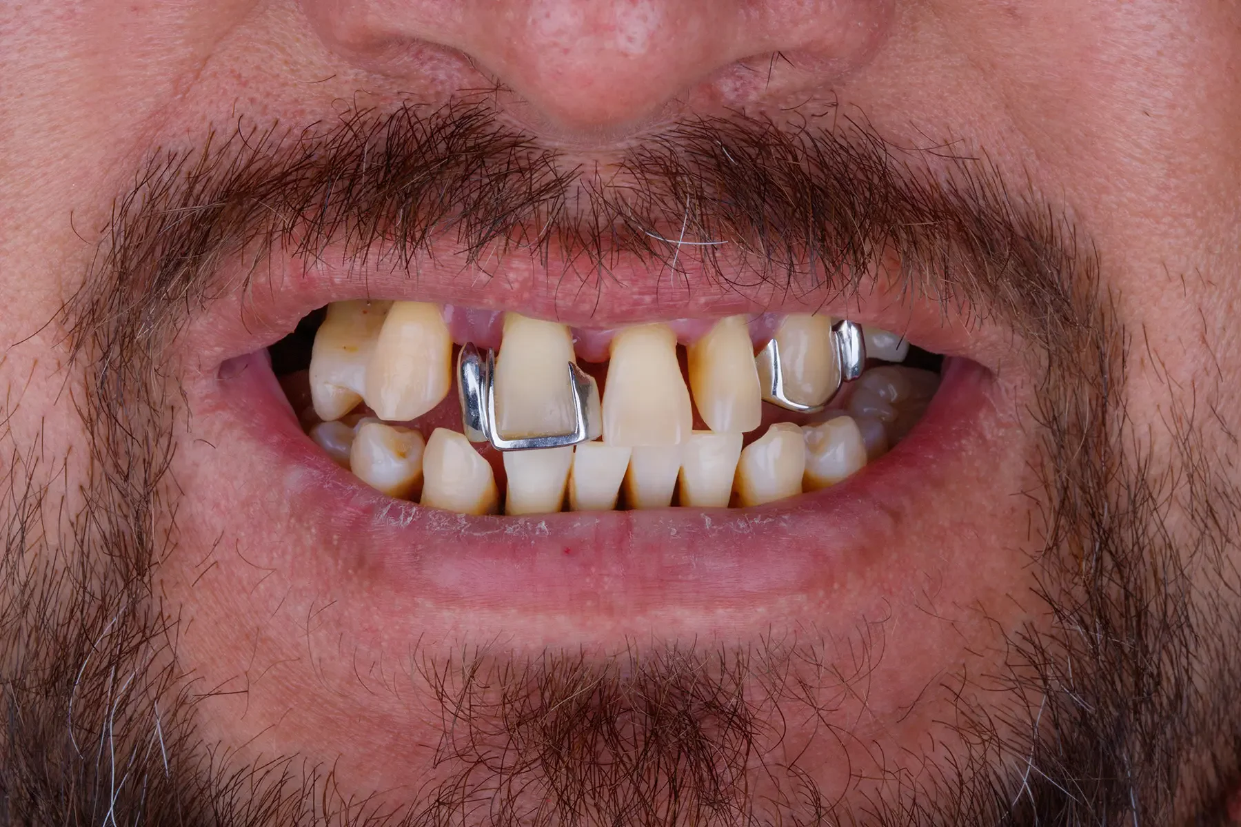 Before treatment — Full-arch restoration replacing a partial denture